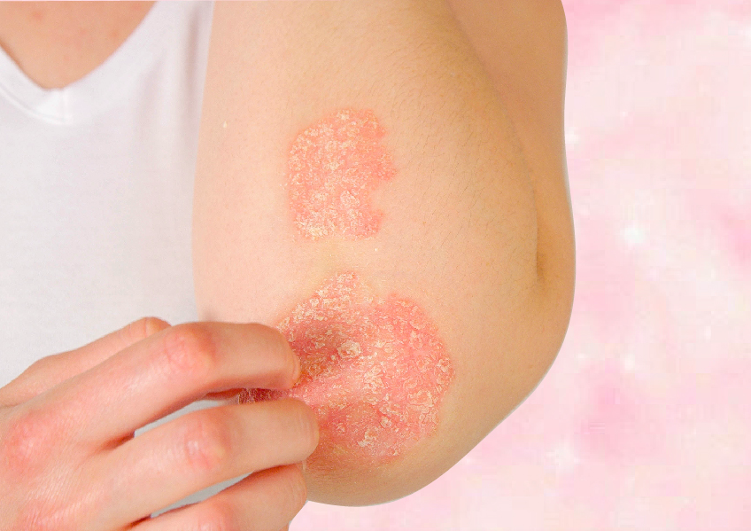 The Ultimate Guide To Psoriasis: What Causes It And How To Treat It ...