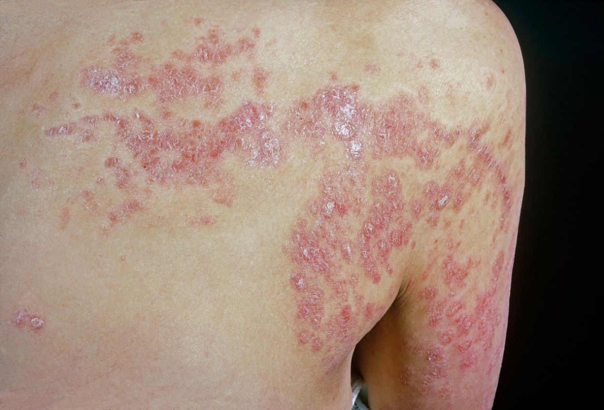 These Detailed Pictures Show Exactly What Different Types of Psoriasis ...