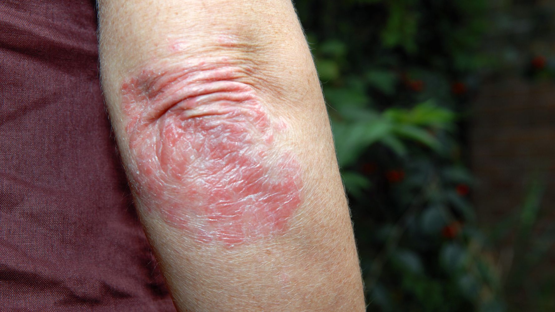 This Is What People With Psoriasis Want You To Know ...