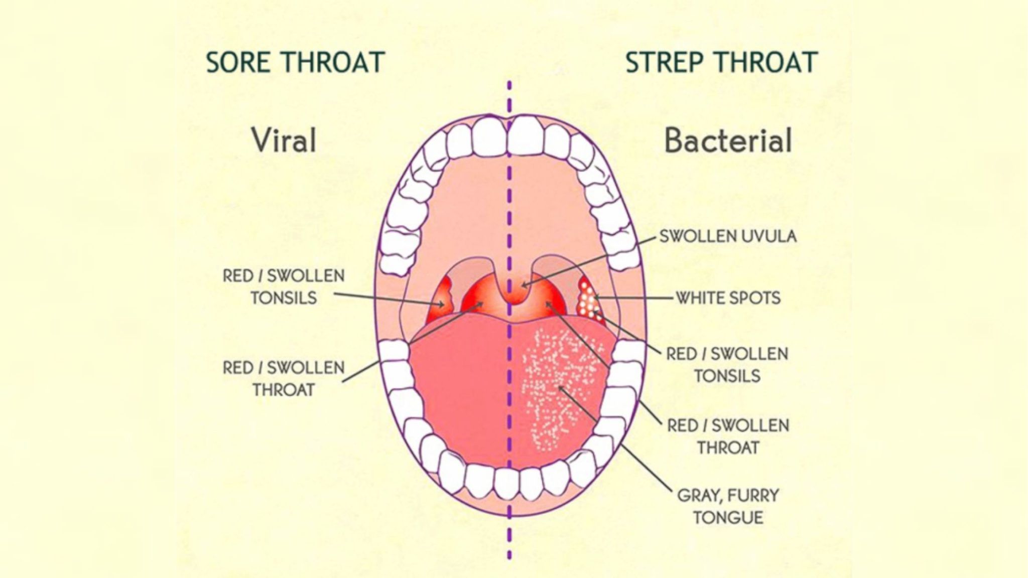 Throat Infections and Psoriasis Connection â OffPsoriasis