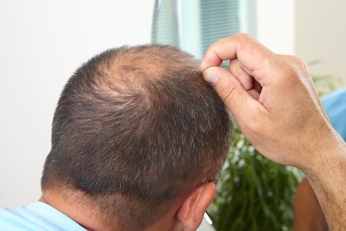 Tips For Coping With Hair Loss Caused By Scalp Psoriasis ...