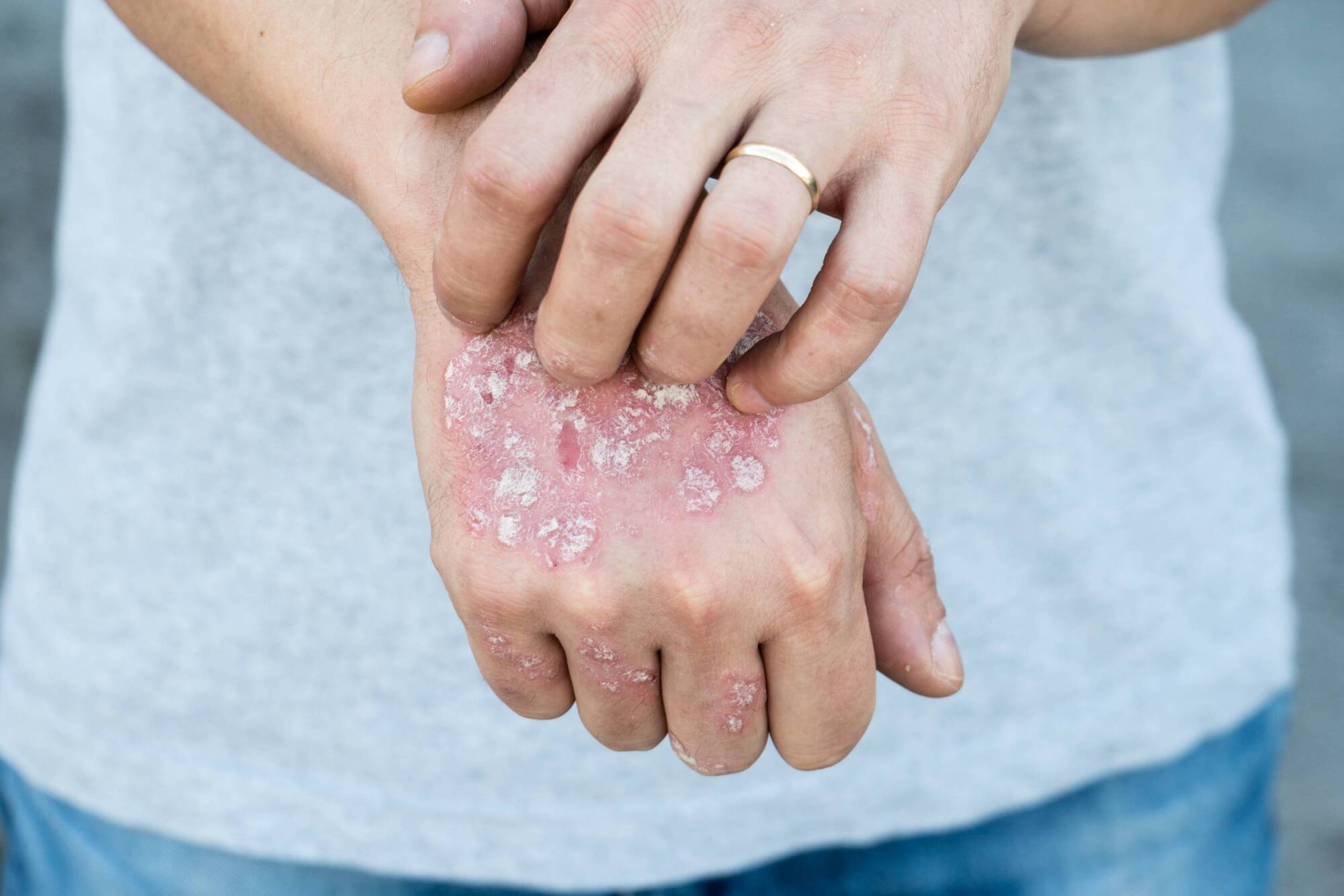 Tips on how you can cope with psoriasis