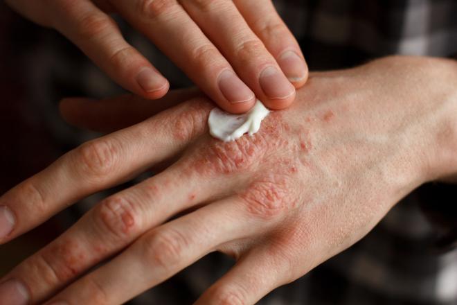 Tips to help avoid psoriasis triggers and flare
