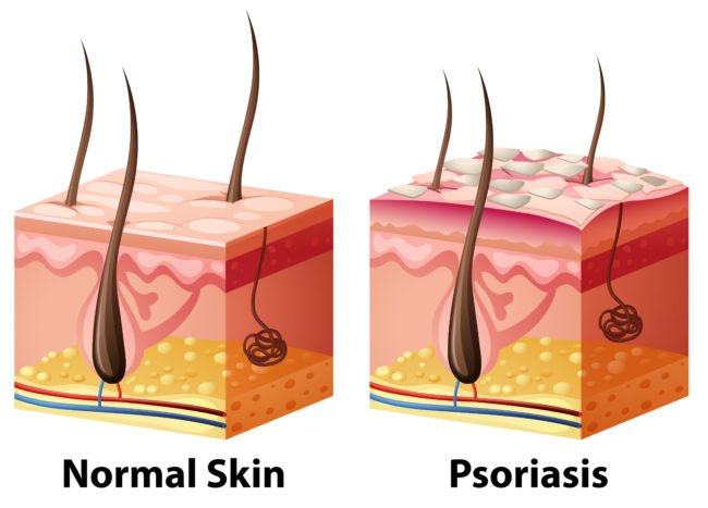 Top 4 Dermatologist Recommended Treatments For Psoriasis ...