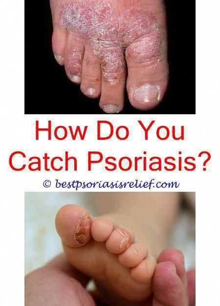 Top Psoriasis Treatments #BestPsoriasisTreatmentInTheWorld ...
