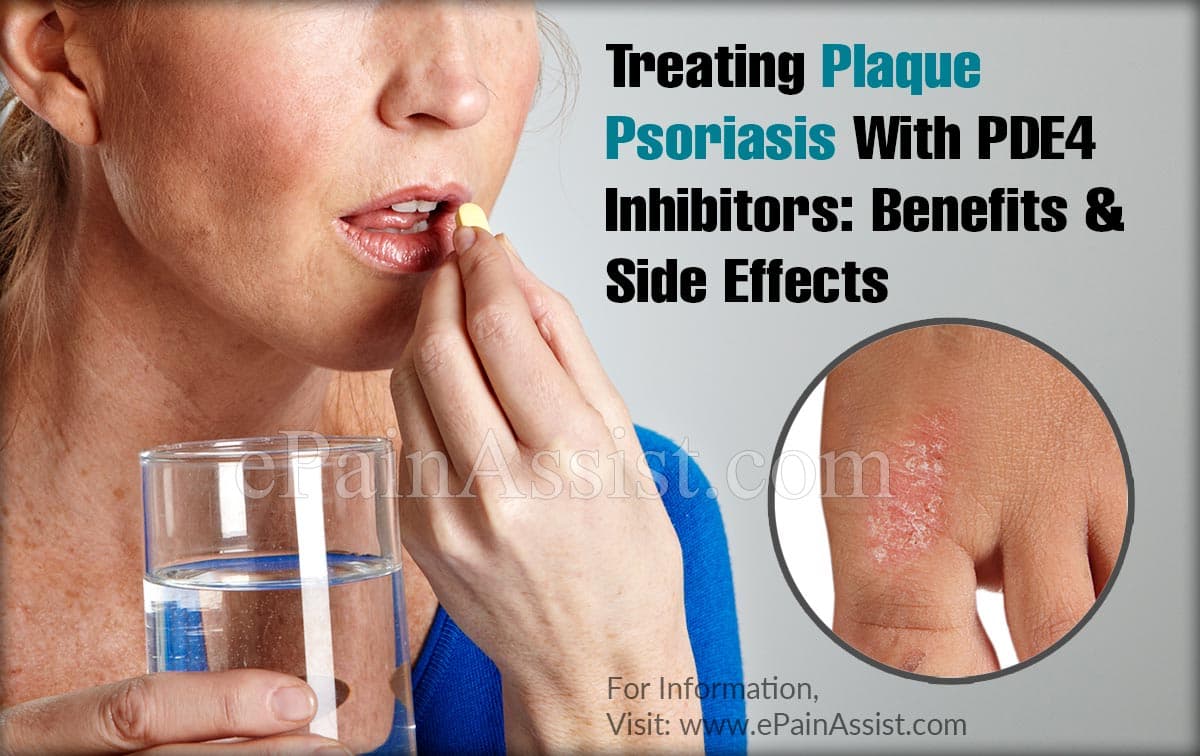 Treating Plaque Psoriasis With PDE4 Inhibitors: Benefits ...