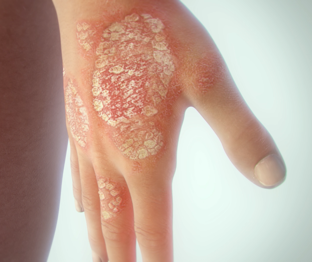 Treating psoriasis from the inside