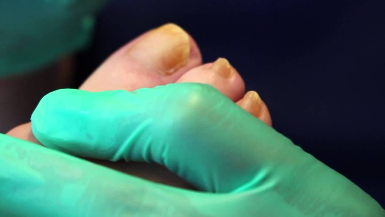 Treating psoriasis on feet