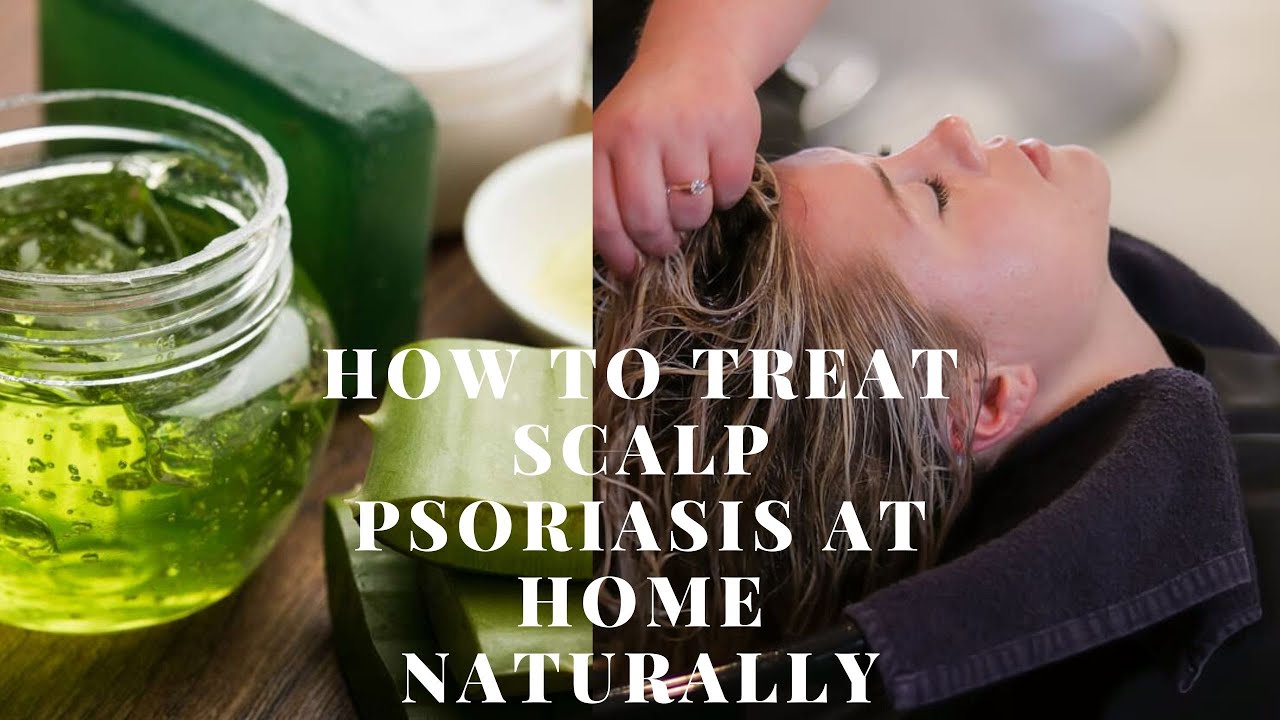 Treating scalp psoriasis at home naturally fast {Home ...