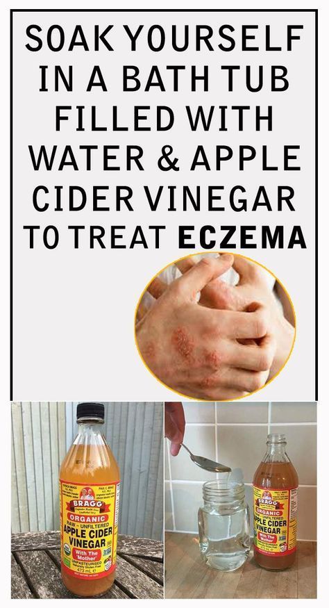 #treatment #methods #vinegar #eczema #apple #cider #how # ...
