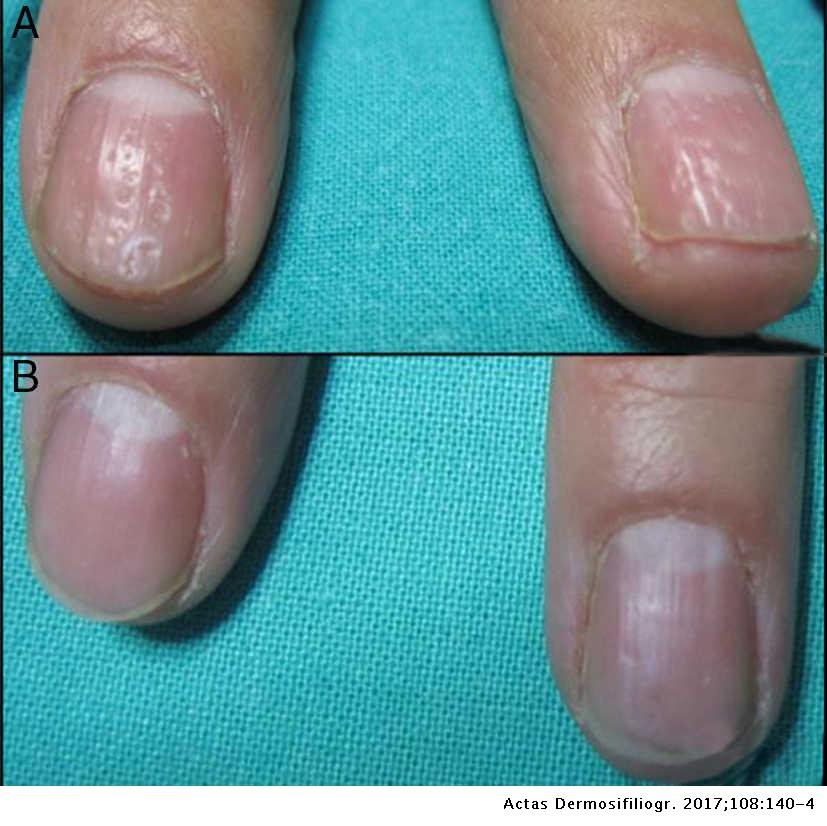 Treatment of nail psoriasis with Pulse Dye Laser plus ...