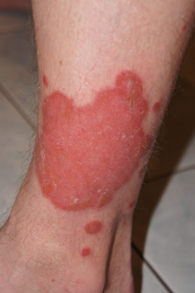 Treatment Options for Different Types of Psoriasis