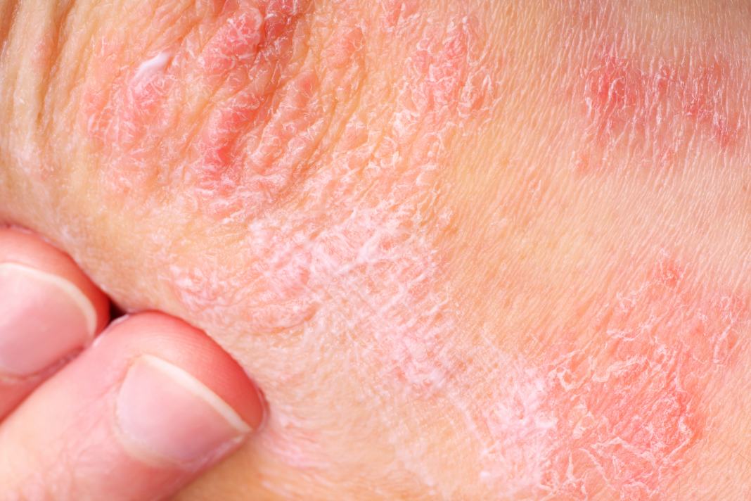 Treatment suggestions for different types of Psoriasis
