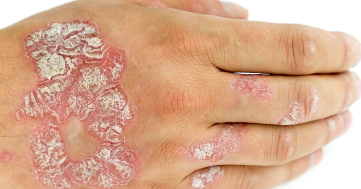 Types of mild psoriasis: Treatment, symptoms, and pictures
