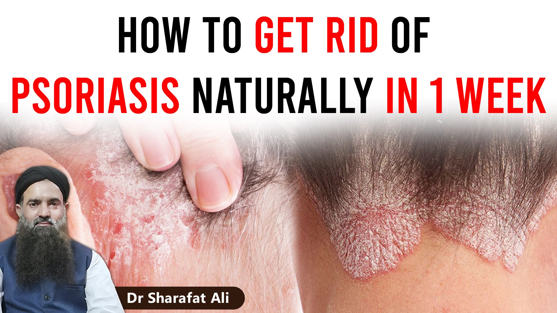 Understand Your Psoriasis and Find the Best Psoriasis ...