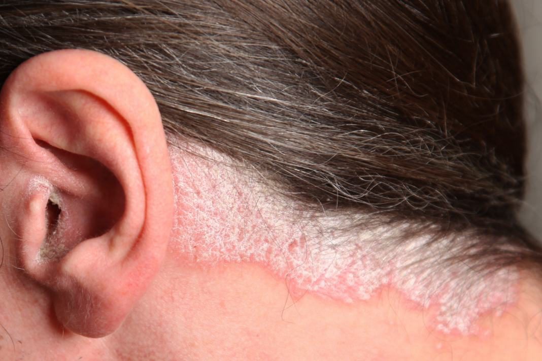 Update on Topical Approaches for Managing Scalp Psoriasis