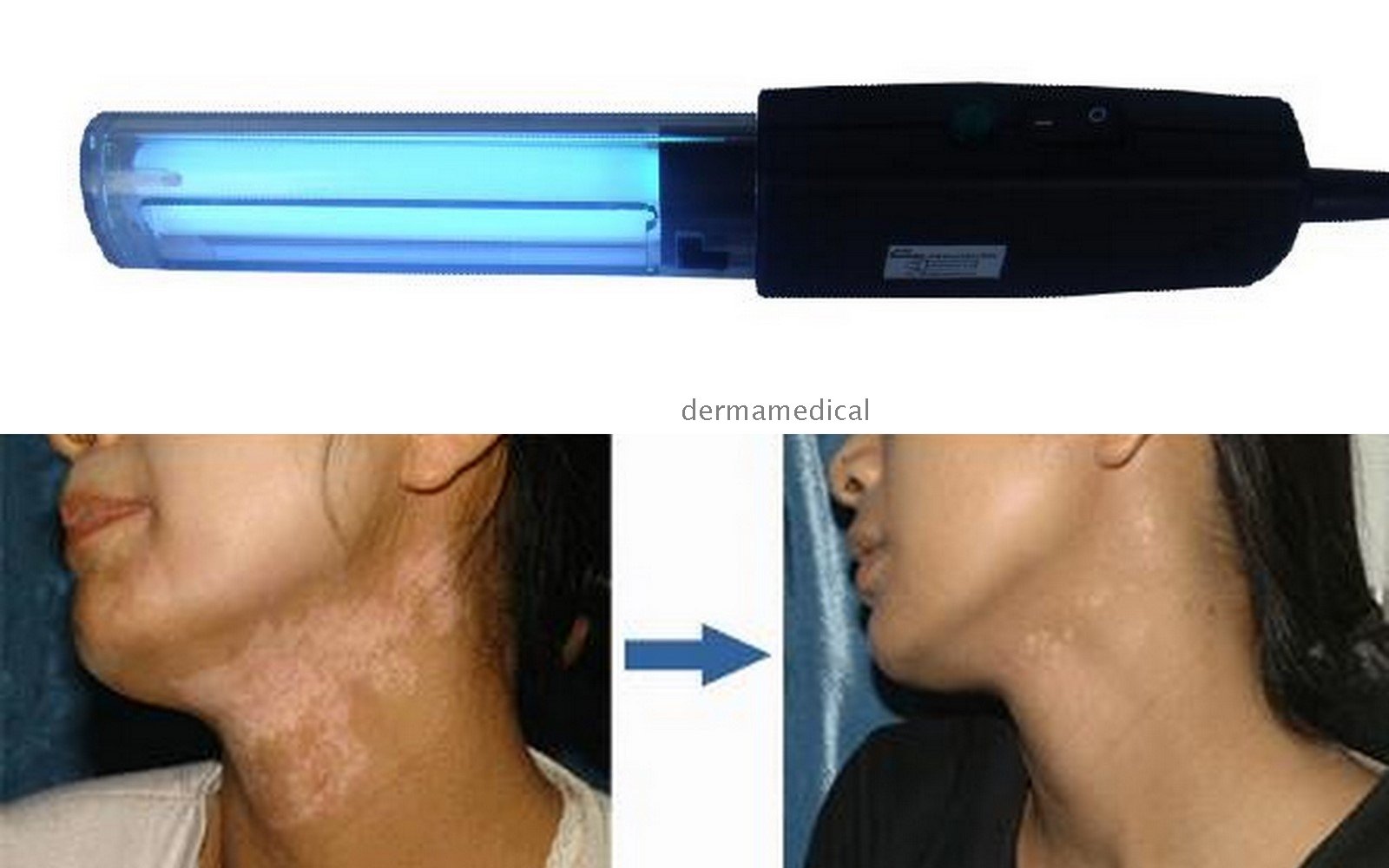 UVB 311nm Lamps Psoriasis Vitiligo Eczema Skin â Wholesale UVB 311nm ...