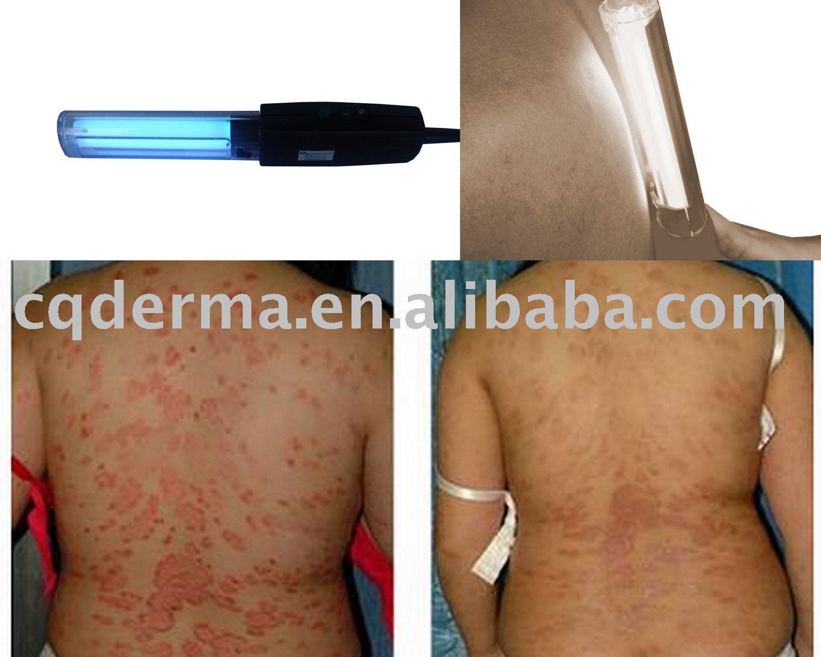 UVB 311nm Phototherapy Psoriasis Virgilio Eczema Treatment