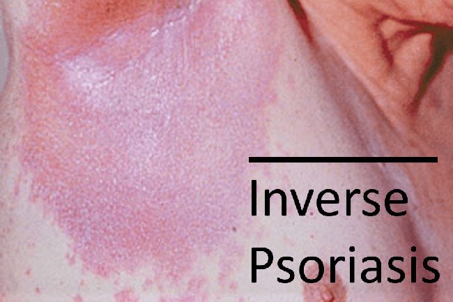 Warnings: 6 Types of Psoriasis and 4 Skin Conditions You Need to Know ...