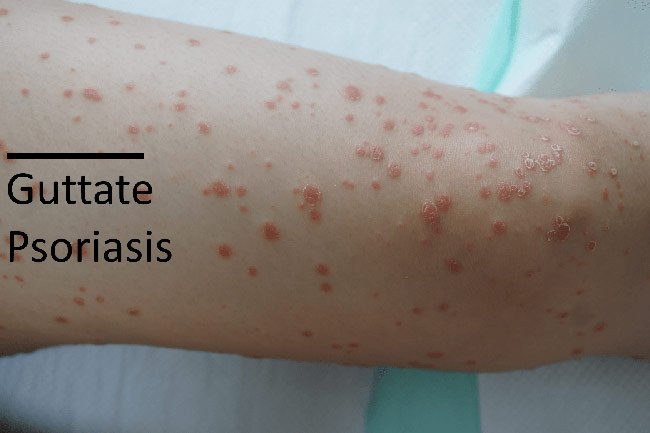 Warnings: 6 Types of Psoriasis and 4 Skin Conditions You ...