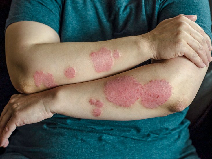 Watch Out! Psoriasis, a type of skin disease for which ...