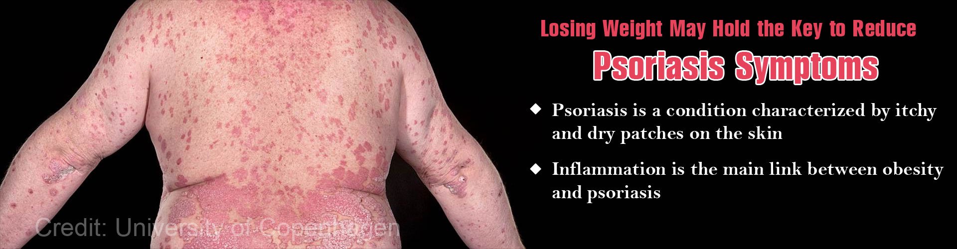 Weight Loss May Show New Hope in the Treatment of Psoriasis