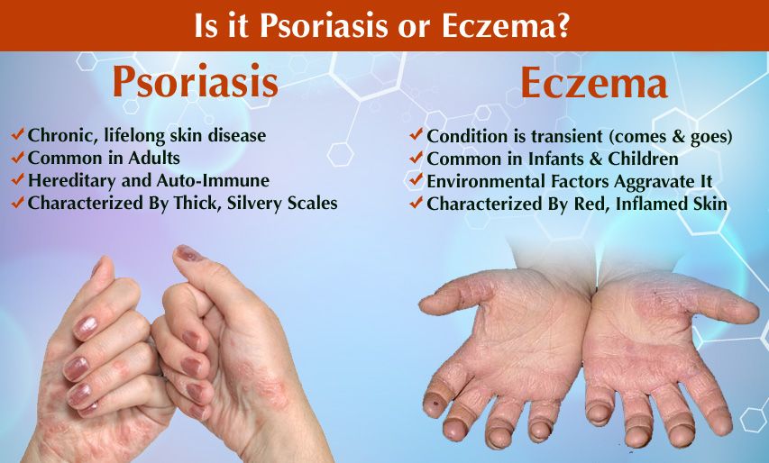 What are The Difference between Eczema and Psoriasis