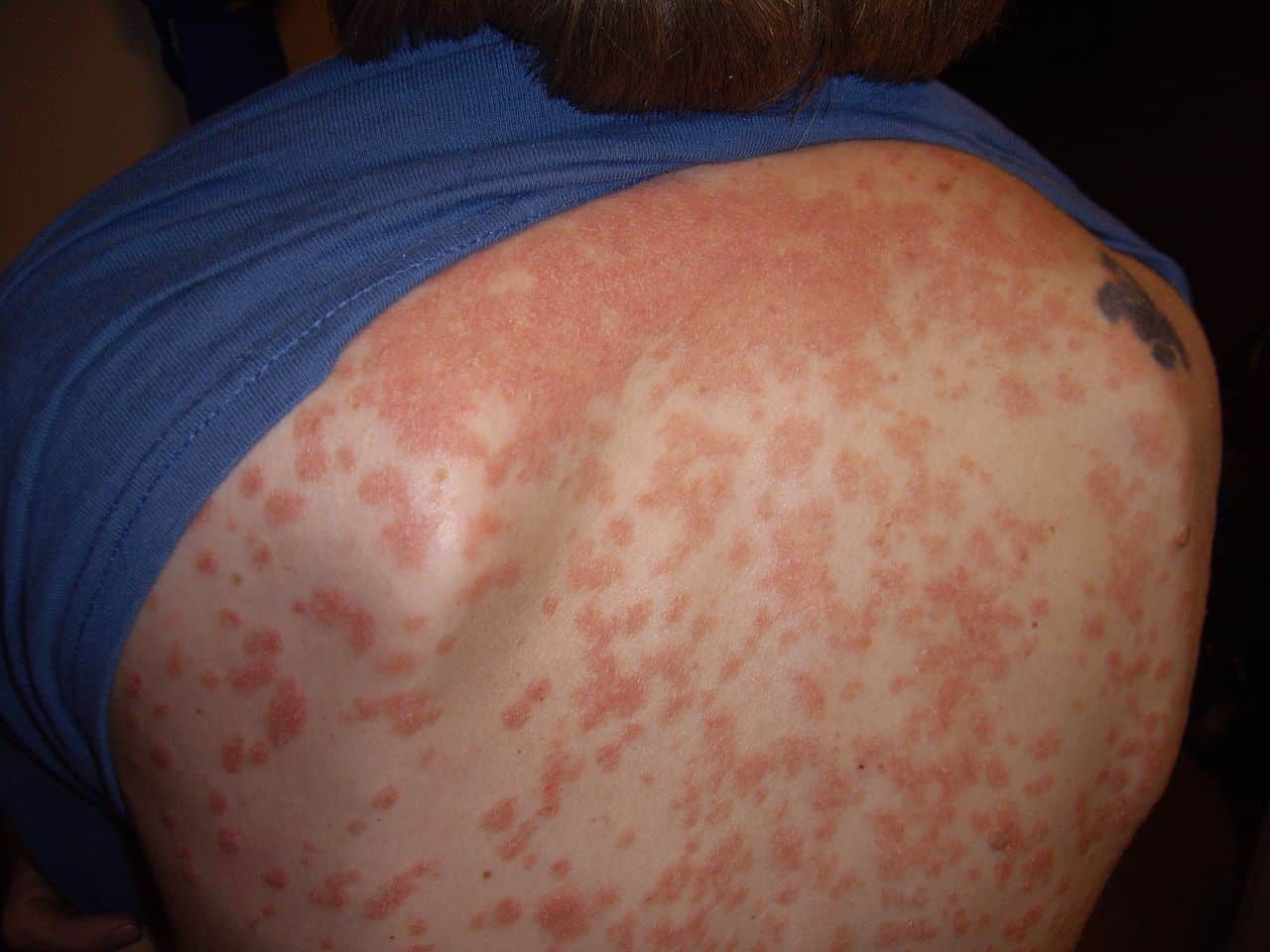 What are the Signs &  Symptoms of Psoriasis?