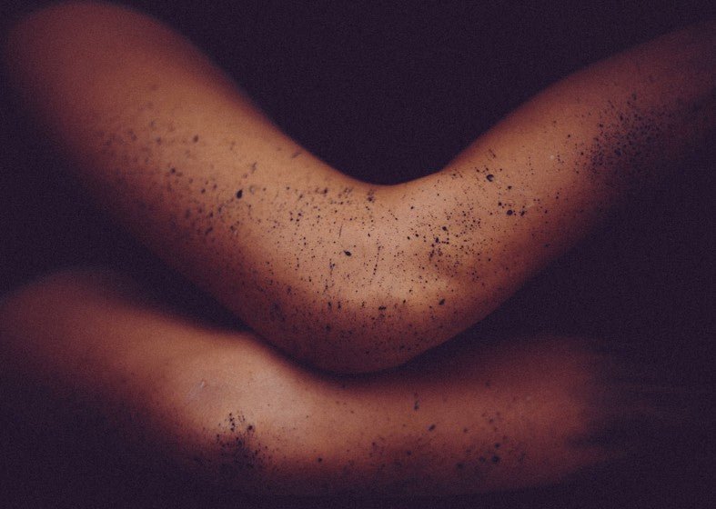 What can be mistaken for Psoriasis?  ITCHY