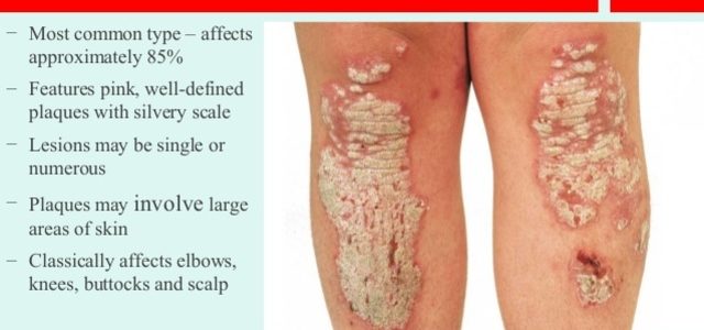 What Causes Chronic Plaque Psoriasis