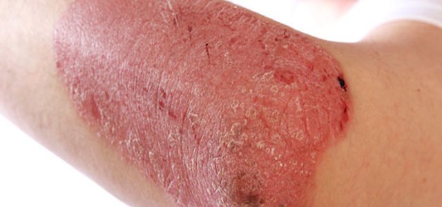 What Causes Of Plaque Psoriasis