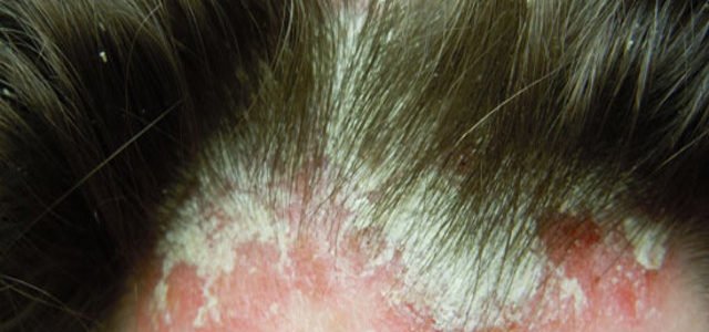 What Causes Plaque Psoriasis On Scalp