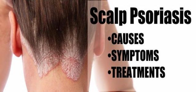 What Causes Plaque Psoriasis On The Scalp