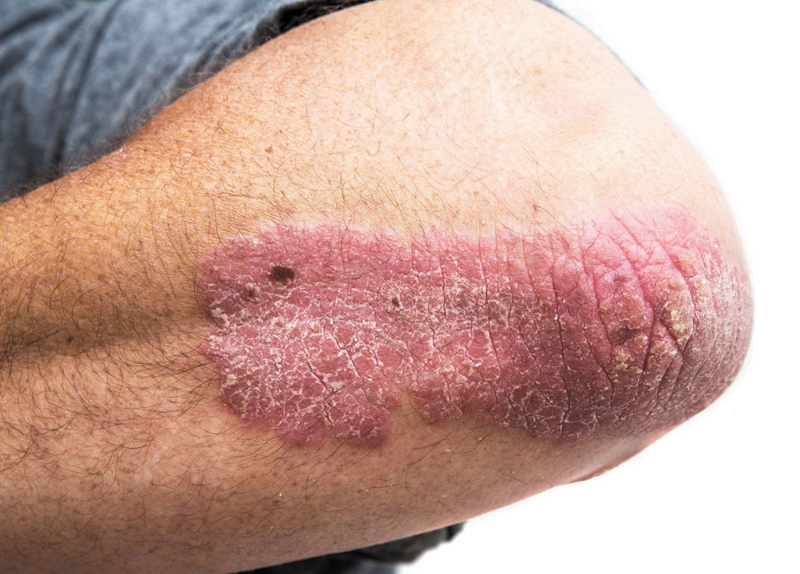 What Causes Psoriasis