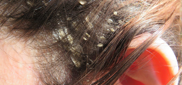 What Causes Psoriasis Of The Scalp To Flare Up