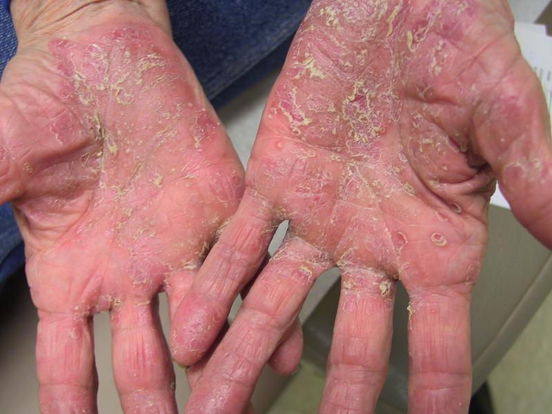 What Causes Psoriasis on Hands