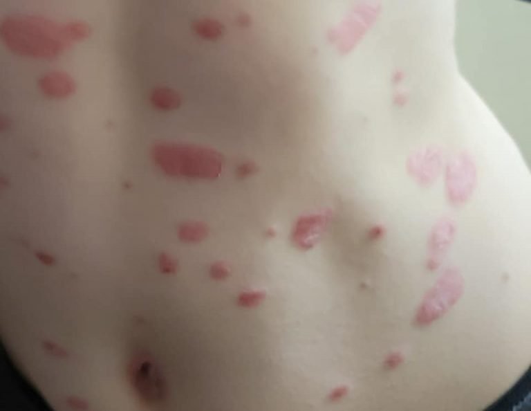 What Does Child Psoriasis Look Like ? (PICTURES And Story)