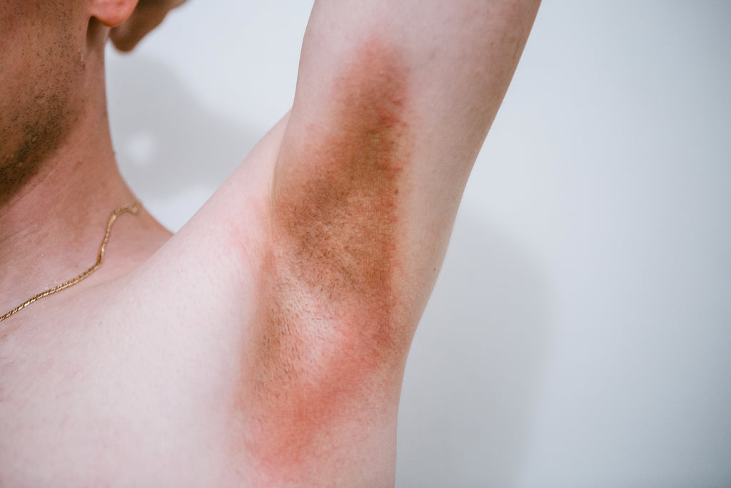 What Does Inverse Psoriasis Look Like?