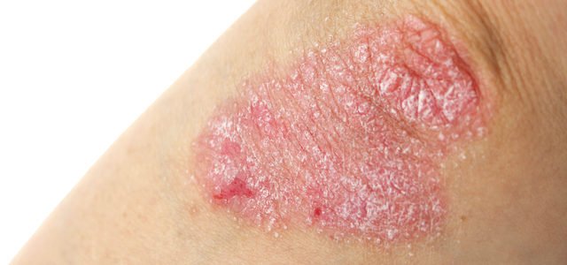 What Does Plaque Psoriasis Look Like