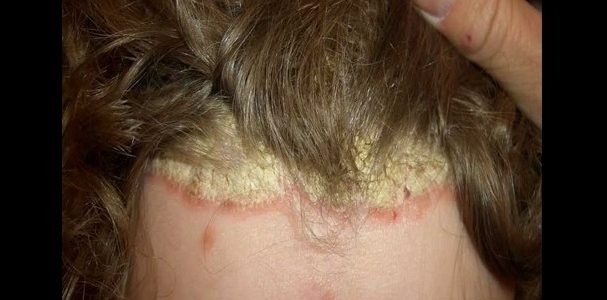 What Does Plaque Psoriasis Look Like On Your Scalp ...