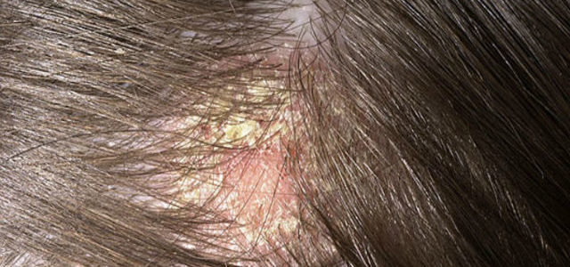 What Does Psoriasis Look Like On The Scalp