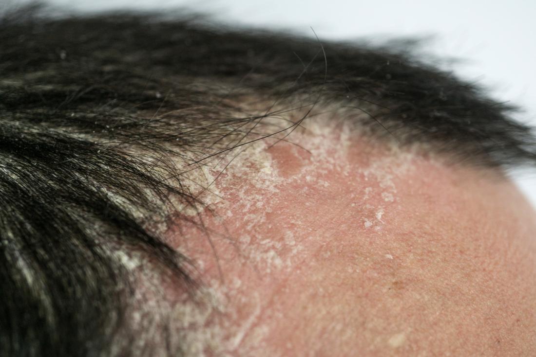 What does psoriasis look like on the scalp