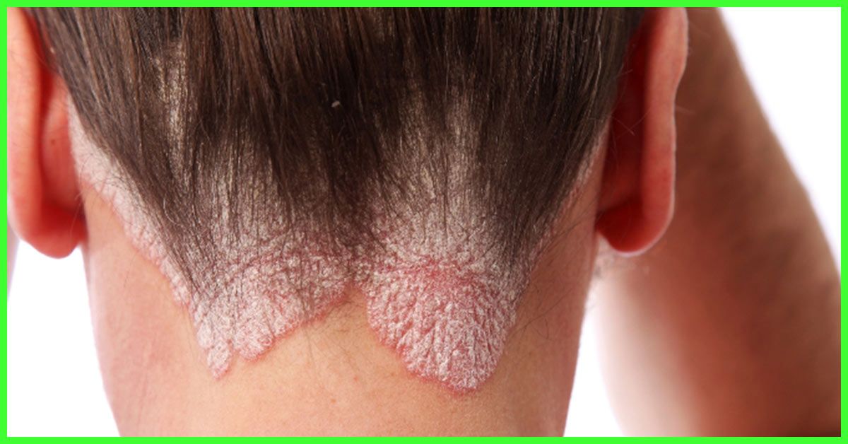 What Does Psoriasis Look Like On The Scalp
