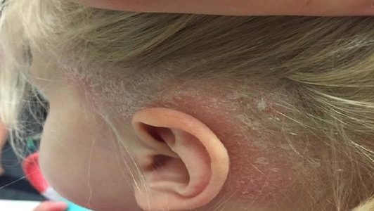 What Does Psoriasis Look Like On Your Scalp