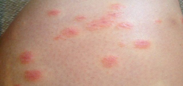 What Does Psoriasis Look Like When It First Appears ...