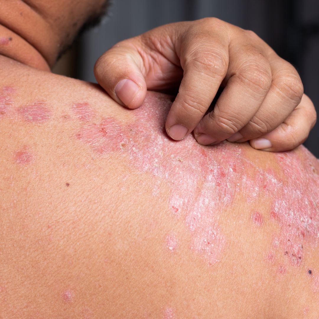 What does psoriasis look like when it starts?