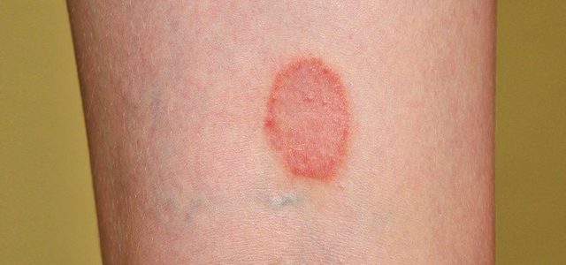 What Does Psoriasis Look Like When It Starts