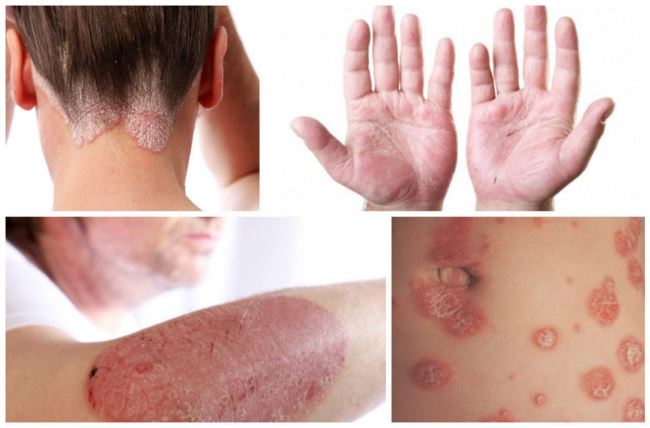What Does Psoriasis On The Skin Look Like