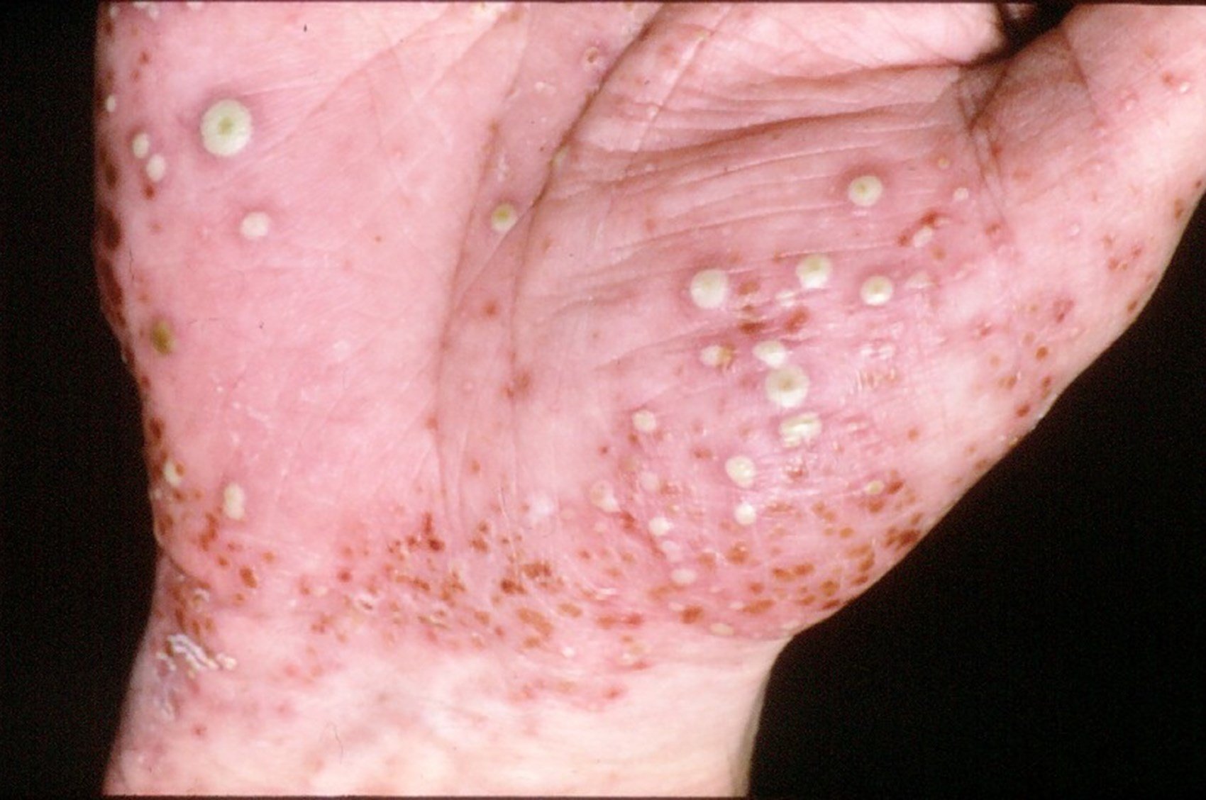 What does pustular psoriasis look like and how is it ...