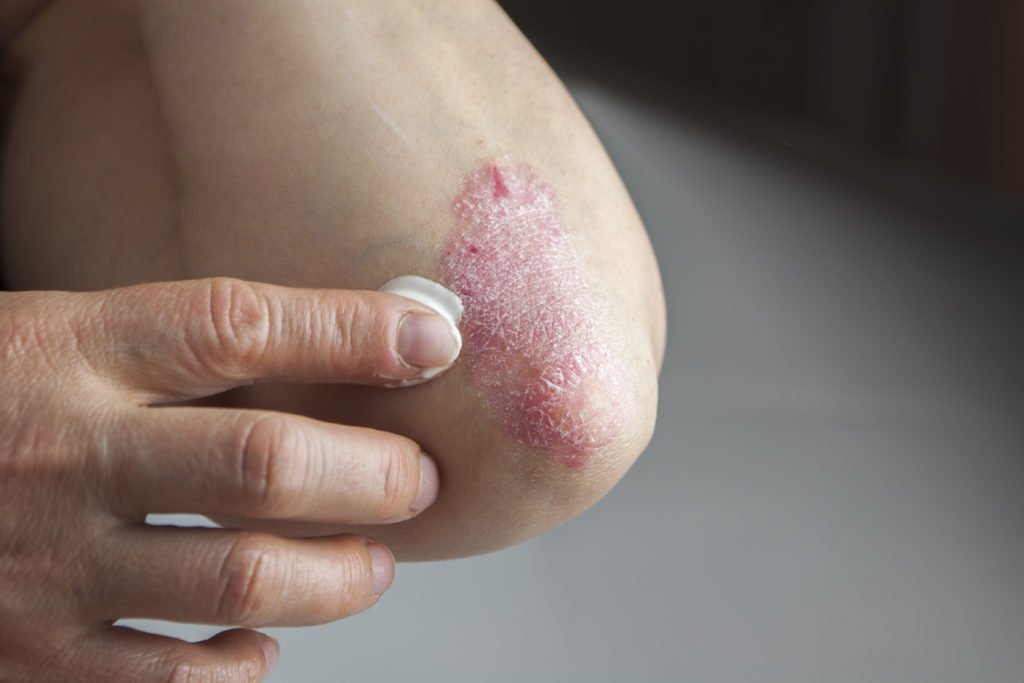 What Does The Beginning Of Psoriasis Look Like?